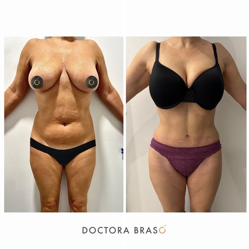 Before and After Result